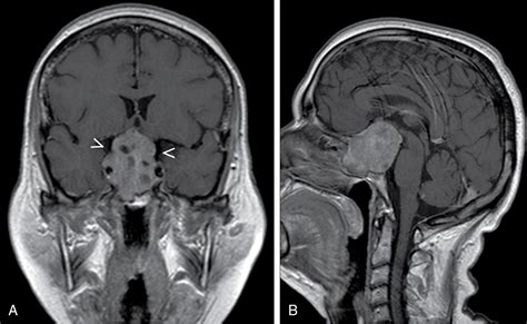 testing the seal on dura reconstruction after pituitary adenoma removal|sublabial incision pituitary tumor.